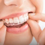 Best Invisalign treatment in dubai