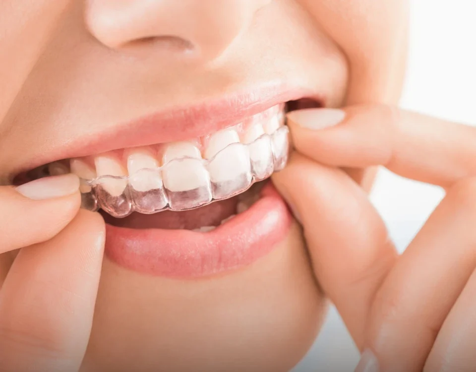 Best Invisalign treatment in dubai
