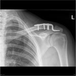 AC joint dislocation in dubai