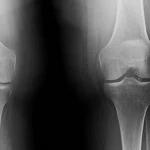 treatment for arthritis in hips and knees