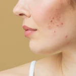 pimple Treatment in Dubai
